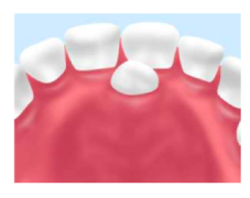 過剰歯の抜歯