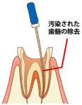 抜髄根管治療