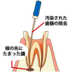 感染根管治療