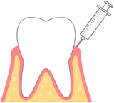 歯周ポケット掻爬(そうは)術